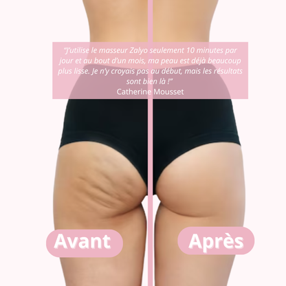 Masseur Anti-Cellulite Manuel - Zalyo™